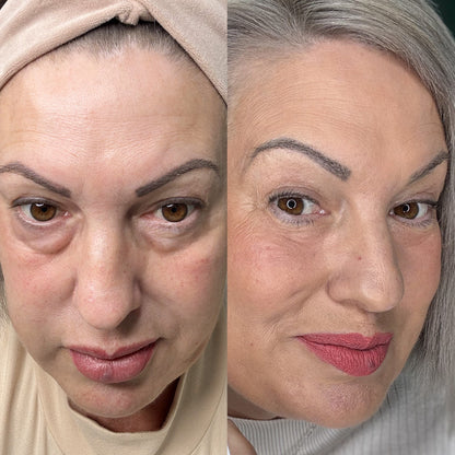 Revital® – Terapia oczu światłem + EMS